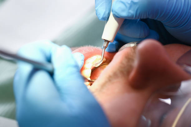 Best Emergency Dental Care for Broken or Chipped Teeth in Sierra Madre, CA