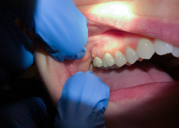 Best Emergency Treatment for Dental Infections or Abscesses in Sierra Madre, CA